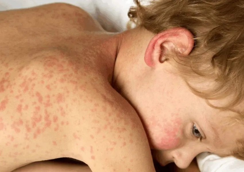 A child with measles.